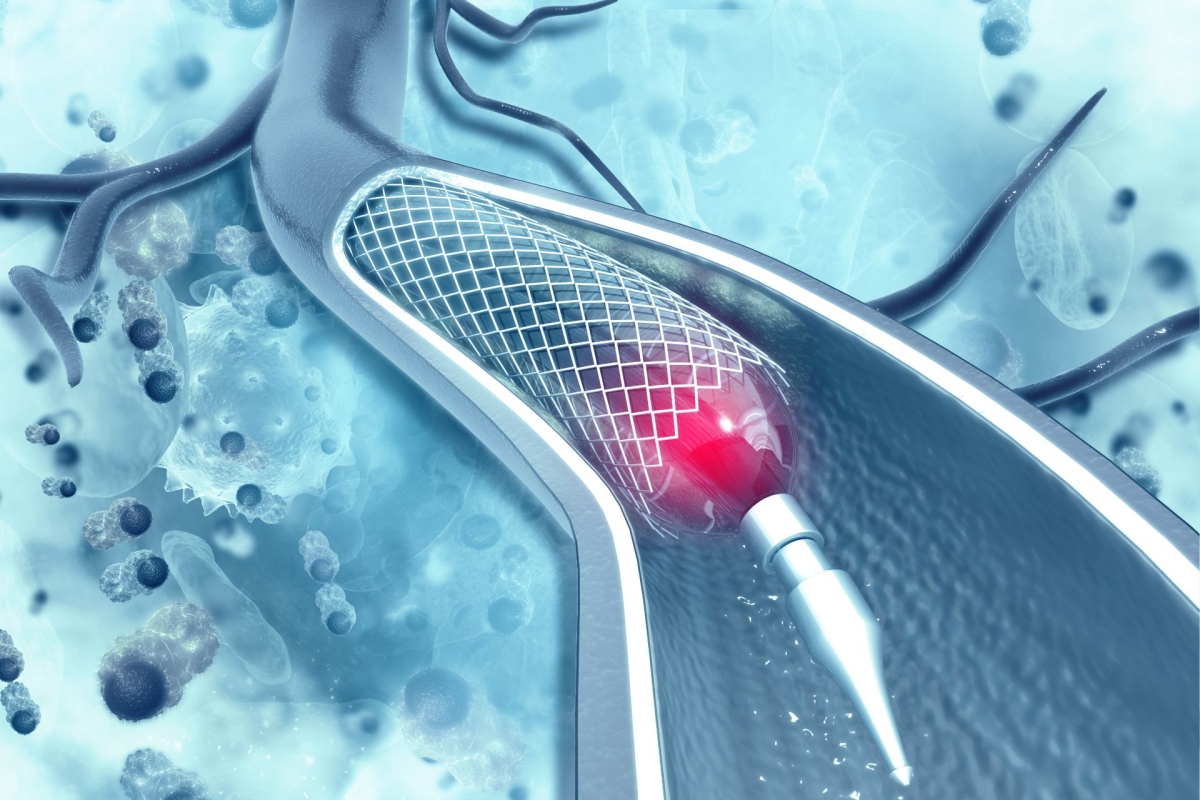 Παρακολούθηση ρυθμού με implantable Loop Recorder